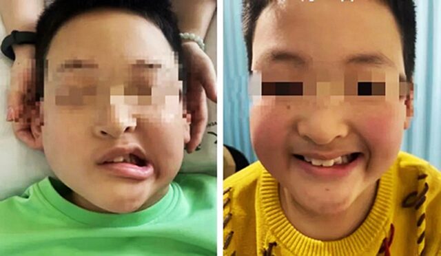 Bé trai 11 tuổi méo miệng do liệt dây thần kinh số VII, bác sĩ cảnh báo nguyên nhân thường gặp