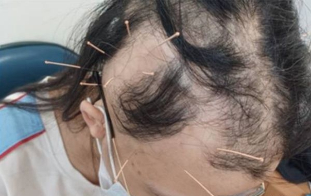 Đột nhiên tóc rụng từng mảng tới "hói trắng cả đầu", nữ sinh bàng hoàng khi nghe bác sĩ tiết lộ nguyên nhân dot nhien toc rung tung mang toi hoi trang ca dau nu sinh bang hoang khi nghe bac si tiet lo nguyen nhan